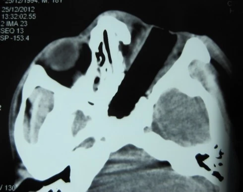 Ngã xe máy bị thanh gỗ xuyên thủng mắt ảnh 1