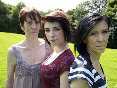 Phẫu thuật cho bé gái 16 tuổi mang gương mặt bà cụ ảnh 2