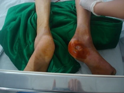 Phẫu thuật cho bệnh nhân bị hoại tử chân ở Cần Thơ ảnh 1