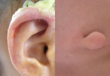 Tái tạo vành tai dị dạng cho trẻ ảnh 1