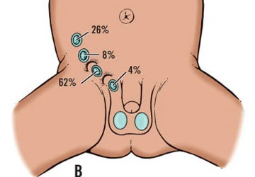 Tuổi trung niên, hai chị mới biết có tinh hoàn ảnh 1