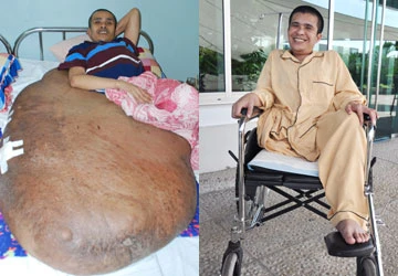 Hải “chân voi” sắp ra viện ảnh 1