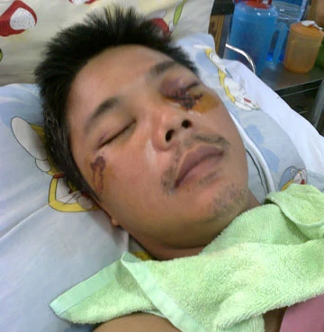 Bảo vệ dân phố đánh người dập não ảnh 1