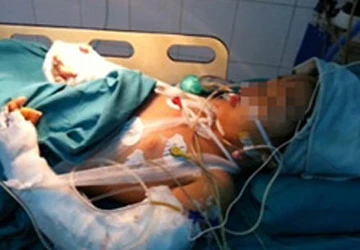 Bé gái ở tiệm vàng có thể phục hồi bàn tay nối ảnh 1