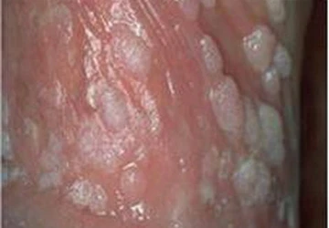 Nam giới nhiễm virus HPV cũng tương đối phổ biến ảnh 1