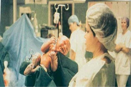 Không khuyến khích sản phụ thai to đẻ thường ảnh 2