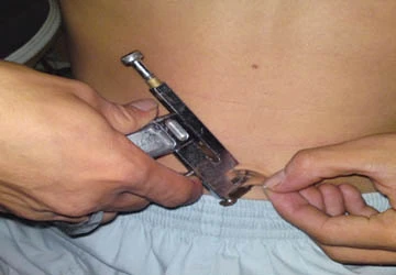 Rùng mình chuyện dùng súng bấm lỗ … “chỗ ấy” ảnh 3