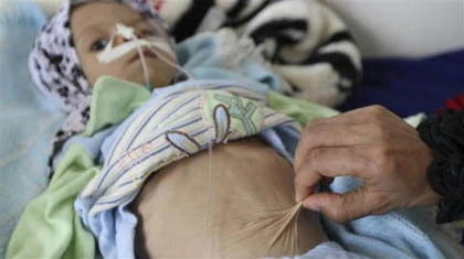 Những đứa trẻ teo tóp đáng thương ở Yemen ảnh 5