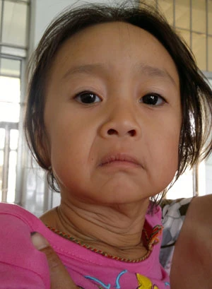 Bé 3 tuổi có diện mạo bà lão ở Cà Mau: Có hiện tượng bị lão hóa da ảnh 1