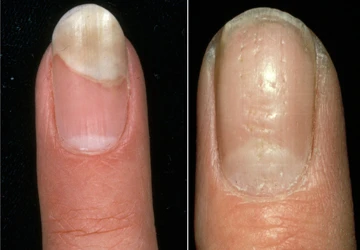 Phương pháp mới cho bệnh lupus ban đỏ và vẩy nến tự miễn ảnh 1