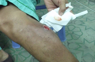 Suýt cưa chân vì đắp lá dâm bụt, gan cóc lên vết xước ảnh 1