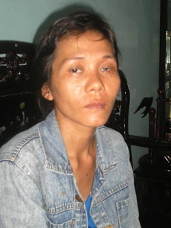 Mắt trái của chị Hiếu bị hỏng vì chai 7up phát nổ. Ảnh: KL