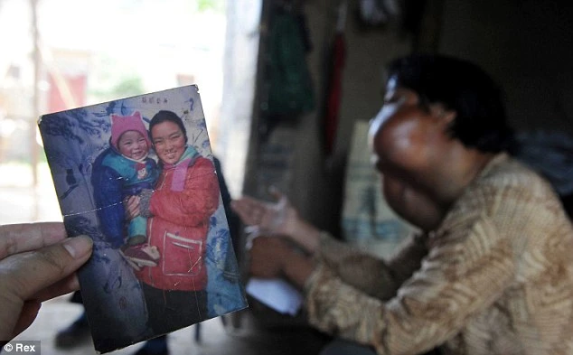 Bệnh lạ: Người phụ nữ có khuôn mặt... xấu xí ảnh 2