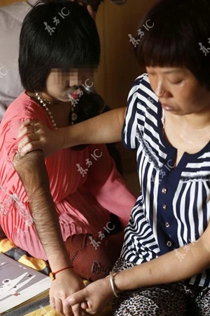 Lông mọc khắp cơ thể bé gái 9 tuổi ảnh 2