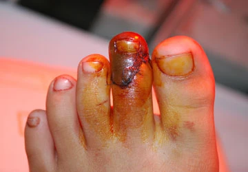 Miếng inox pô xe cắt chân người: Ai xử, xử ai? ảnh 2 Miếng inox pô xe cắt chân người: Ai xử, xử ai? ảnh 2