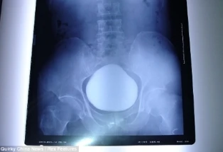 Mổ lấy sỏi bàng quang khổng lồ nặng hơn 1 kg ảnh 1