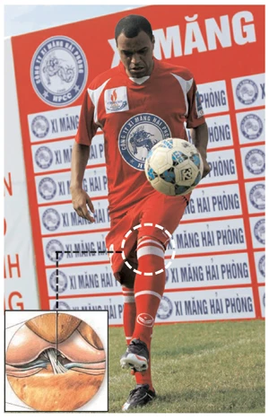 Gối trái Denilson trong buổi biểu diễn đã có vấn đề về dây chằng và sụn chêm nhưng đã được “ém” đi. Ảnh: QUANG THẮNG