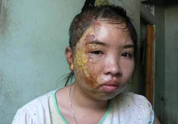 Cha dượng dội nước sôi con riêng của vợ ảnh 1