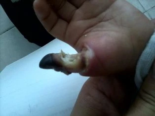 Bé trai bị cắt cụt ngón cái vì phỏng điện ảnh 1