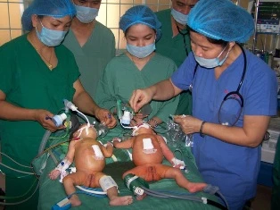 Kon Tum: Phẫu thuật tách cặp song sinh dính nhau ảnh 1