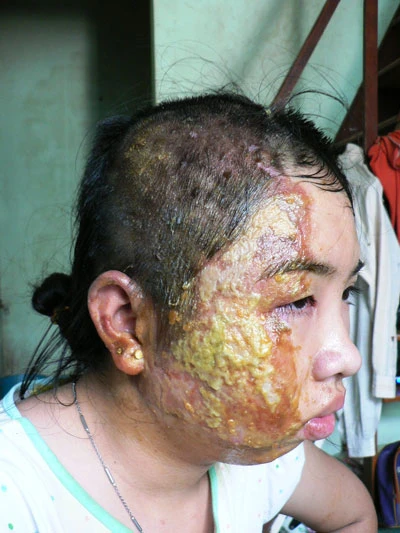 Thiếu nữ bị dội nước sôi bãi nại cho cha dượng ảnh 1