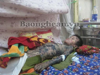 Dị ứng Paracetamol, bé 8 tuổi bị tróc da toàn thân ảnh 1