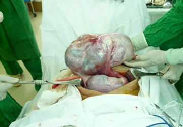 Phụ nữ 78 tuổi mang 2 khối u buồng trứng gần 8kg ảnh 1