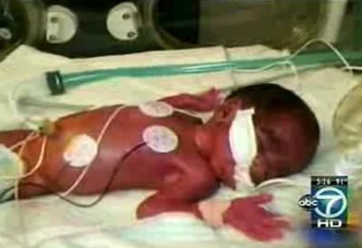 Người phụ nữ cao 90 cm sinh con ảnh 2