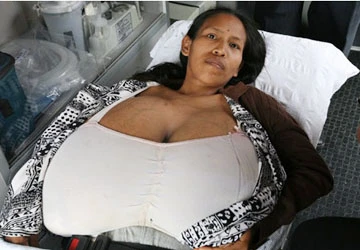 Người phụ nữ bị bệnh ngực to ảnh 1 Người phụ nữ bị bệnh ngực to ảnh 1