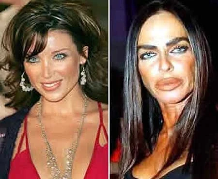 Hóa "Ngáo ộp" vì phẫu thuật thẩm mỹ ảnh 5