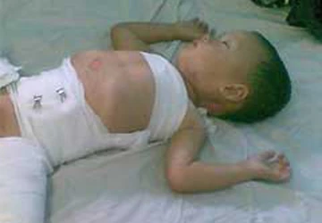 Bà ngoại bất cẩn, cháu bị bỏng toàn thân ảnh 1