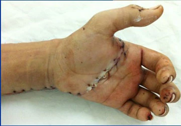 Tự sơ cứu khi bị chặt tay, cứa cổ ảnh 1