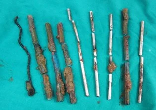 Thủng đại tràng vì nuốt 9 que sắt ảnh 1