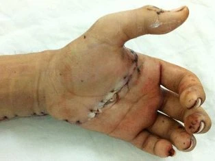 Nối bàn tay đứt lìa cho nam thanh niên Campuchia ảnh 1