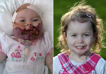 Phương thuốc thần kỳ “cứu” khuôn mặt bé gái ảnh 1