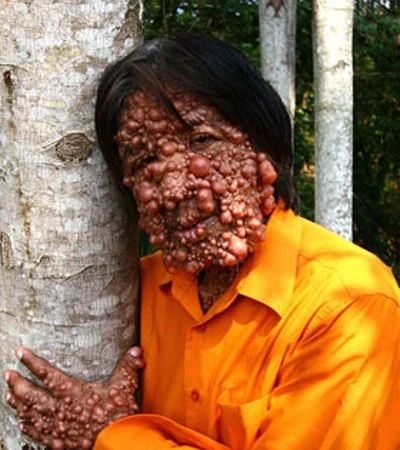 Người đàn ông biến dạng vì mụn mọc như sung ảnh 2