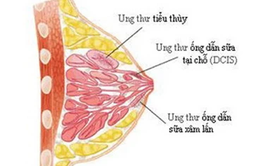 Vắcxin DNA thế hệ mới có tác dụng chống ung thư ảnh 1