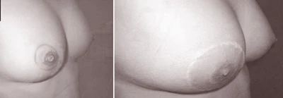 Chữa ung thư vú: Vẫn giữ được “núi đôi” ảnh 1 Chữa ung thư vú: Vẫn giữ được “núi đôi” ảnh 1