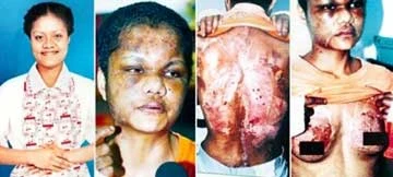 Cô giúp việc Nirmala Bonat (trái) và thương tích trên người lúc bị bà chủ hành hạ.