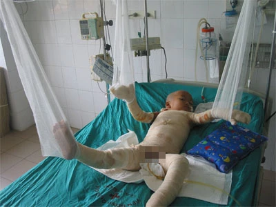 Thương cảnh bé 3 tuổi bỏng toàn thân vì ngã vào hố vôi ảnh 1
