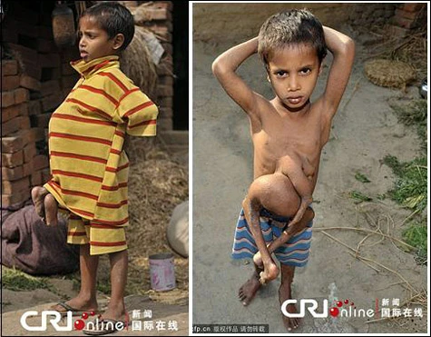 Cậu bé có 4 chân mọc ra từ bụng ảnh 2