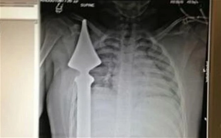 Thoát chết thần kỳ khi bị cọc sắt đâm gần tim ảnh 1 Thoát chết thần kỳ khi bị cọc sắt đâm gần tim ảnh 1