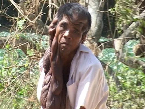 Bị bướu “ăn” nửa mặt ảnh 2