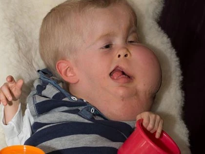 Bé hai tuổi mắc bệnh bí ẩn mặt to hơn thân ảnh 1 Bé hai tuổi mắc bệnh bí ẩn mặt to hơn thân ảnh 1