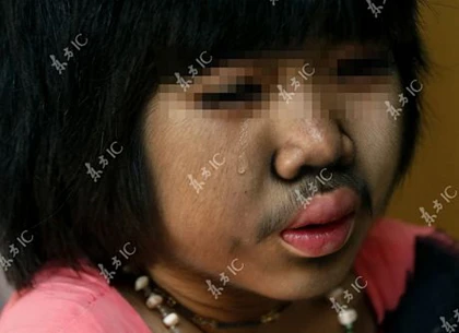 Lông mọc khắp cơ thể bé gái 9 tuổi ảnh 1