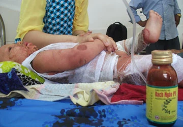 Phú Yên: Dị ứng thuốc, một cháu bé nguy kịch ảnh 1