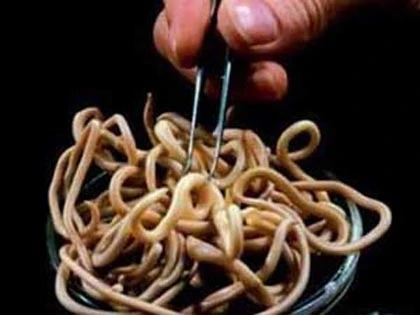 300 con giun làm ổ trong bụng cô gái ảnh 1