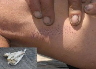 Ngứa phát điên vì bướm “lạ” ảnh 2