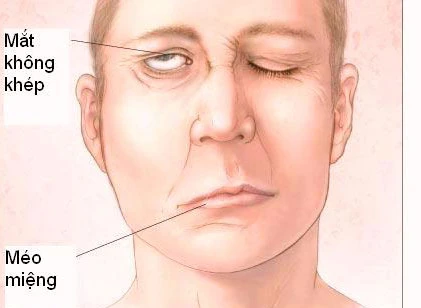 Méo mồm vì cạo gió không đúng cách ảnh 1