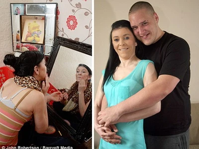 Phẫu thuật cho bé gái 16 tuổi mang gương mặt bà cụ ảnh 3